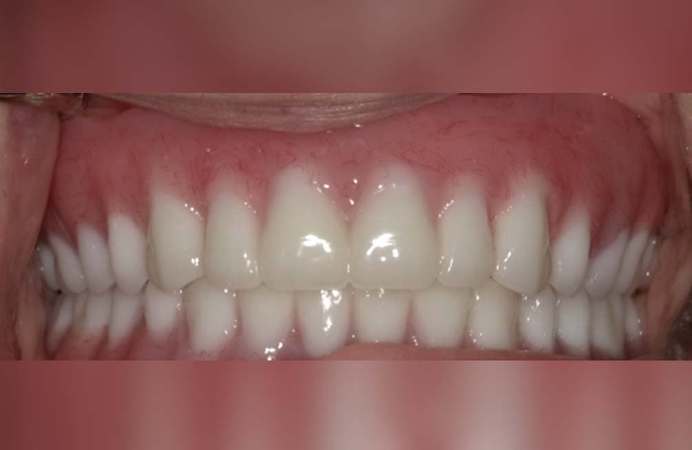 After dental implants