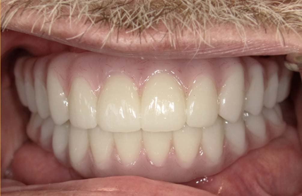 After dental implants