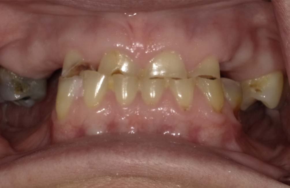 Before dental implants