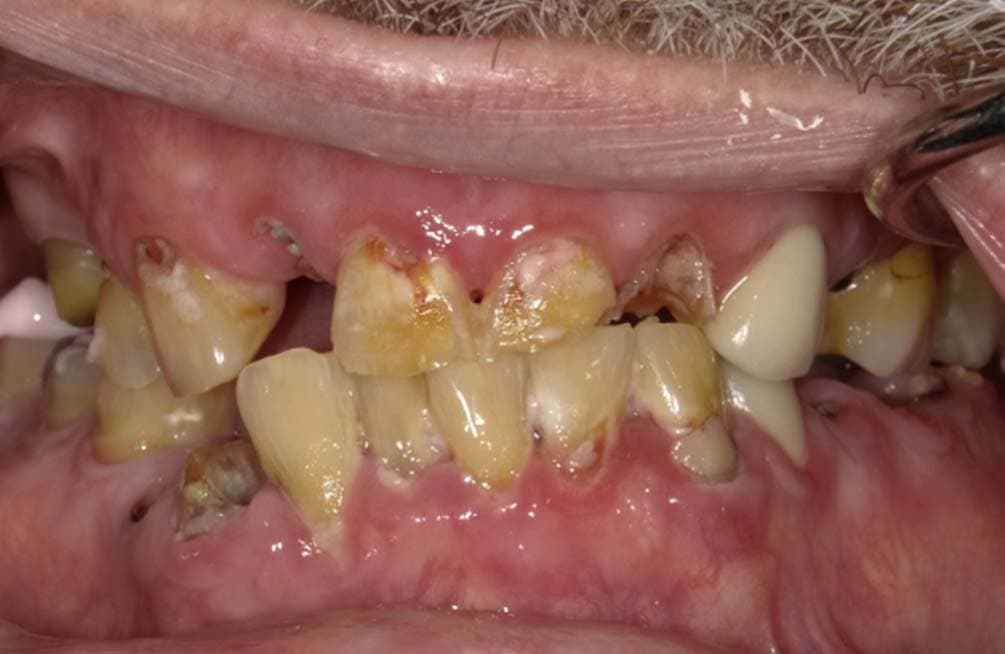 Before dental implants